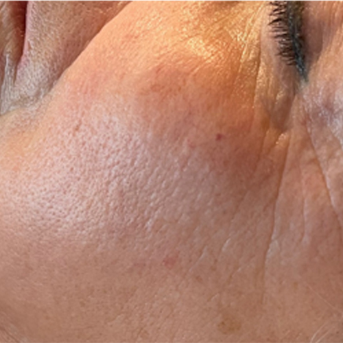 Massage Sur Mesure Méthode LB Facialistes© - Apres